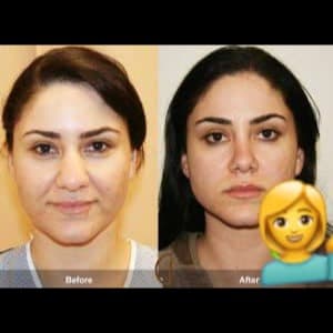 ژل کوچک کننده بینی دکس لاند